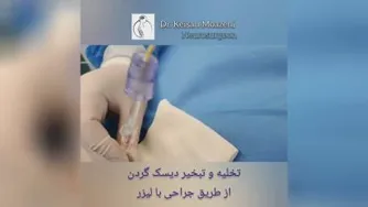 جراحی بسته(لیزری)دیسک گردن