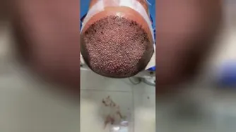 بهترین کاشت مو شیراز