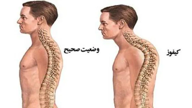 تمرینات اصلاحی کیفوز یا افرایش انحنای پشتی (قوز) قسمت اول