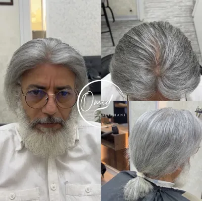 پروتز مو اصفهان