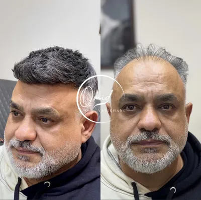 پروتز و تزمیم مو