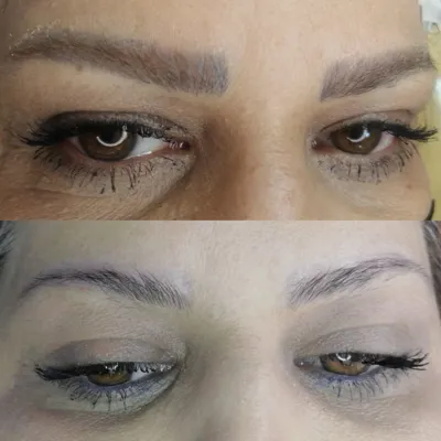 بهترین مرکز لیزر تاتو در تبریز