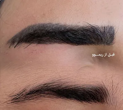 مرکز لیزر تاتو در تبریز