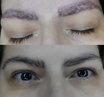 بهترین مرکز لیزر تاتو در تبریز