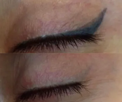 مرکز لیزر تاتو در تبریز