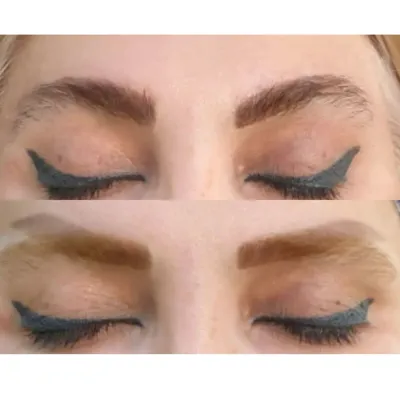 مرکز لیزر تاتو در تبریز