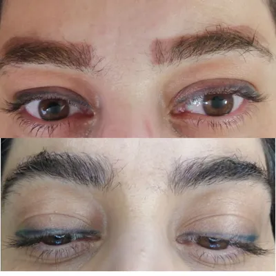 بهترین مرکز لیزر تاتو در تبریز