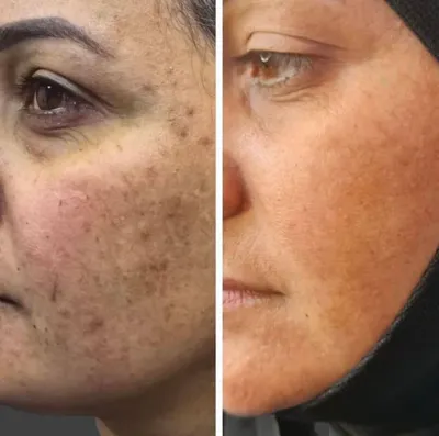 رفع لک، کک و مک های پوستی با لیزر کیوسوییچ در دزفول