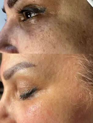 پاک کردن تتو خط چشم با لیزر کیوسوئیچ در دزفول