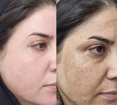 رفع لک و کک و مک با لیزر کیوسوئیچ در دزفول