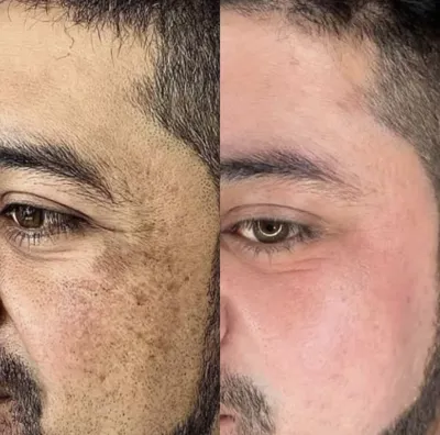 رفع لک با لیزر کیوسوئیچ در دزفول