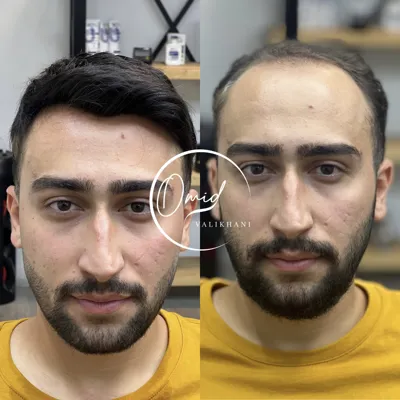 قیمت پروتز مو
