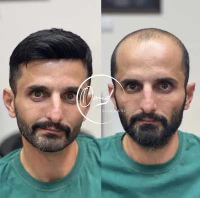 بهترین پروتز مو