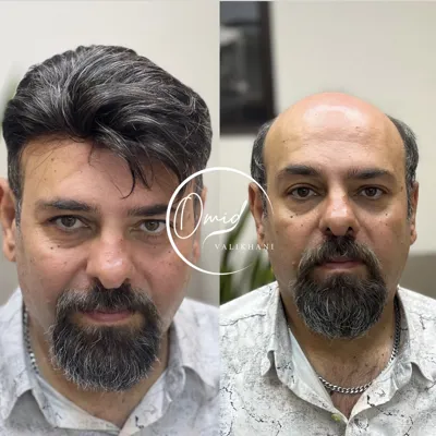 مرکز کاشت مو اصفهان