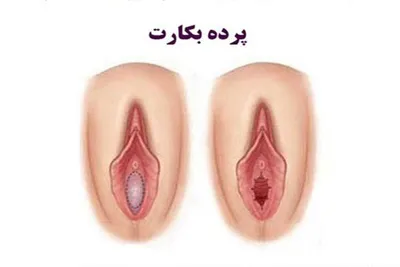 هزینه ترمیم بکارت در خرم اباد