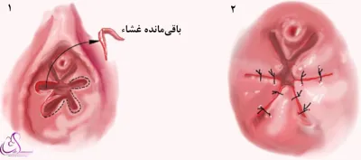 قیمت ترمیم بکارت در خرم اباد