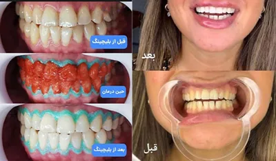 قبل و بعد از بلیچینگ دندان