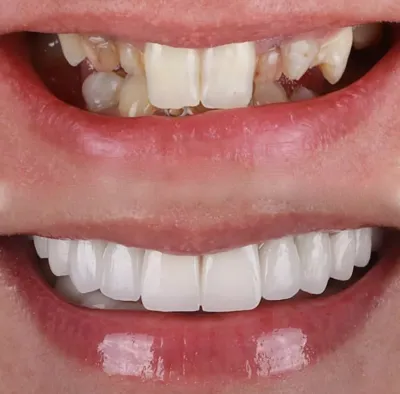 کامپوزیت دندان خرگوشی