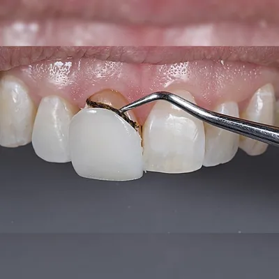 برداشتن کامپوزیت دندان