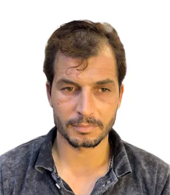 پروتز مو فولادشهر
