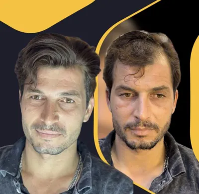 آموزش پروتز مو در شاهین شهر