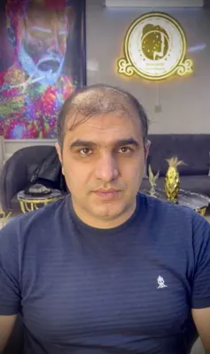 پروتز مو در خمینی شهر