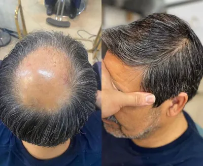 پروتز مو در سپاهان شهر