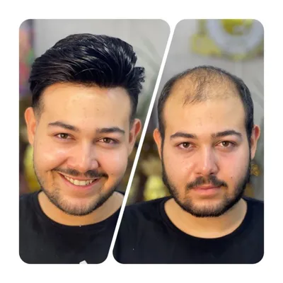 ترمیم پروتز مو در سپاهان شهر
