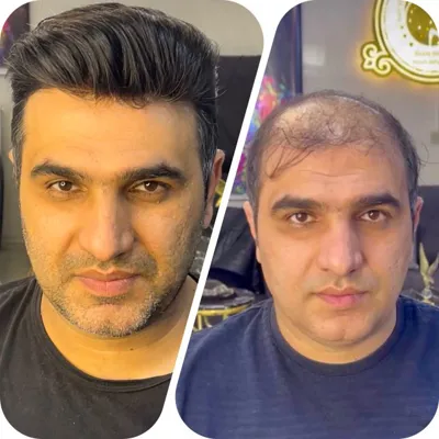 پروتز مو در شهرضا