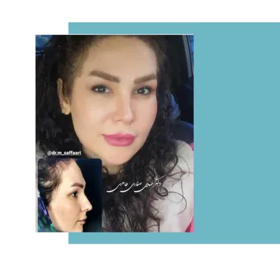 نوع جراحی بینی