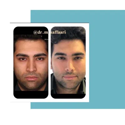 انواع جراحی بینی