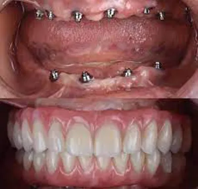 ایمپلنت اقساطی در درچه