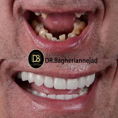 ایمپلنت بدون درد در درچه