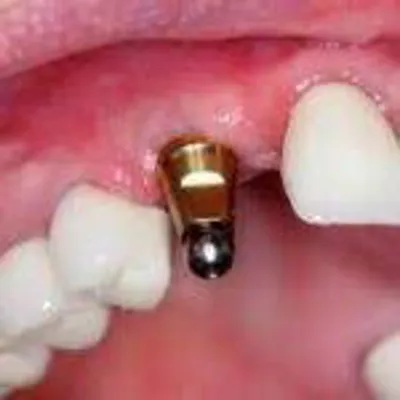 ایمپلنت دندان در تیران و کرون