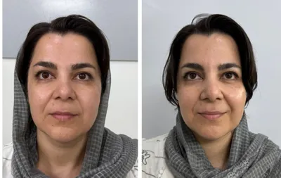 لیزر مو زائد در اصفهان