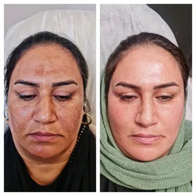 لیزر مو زائد در اصفهان