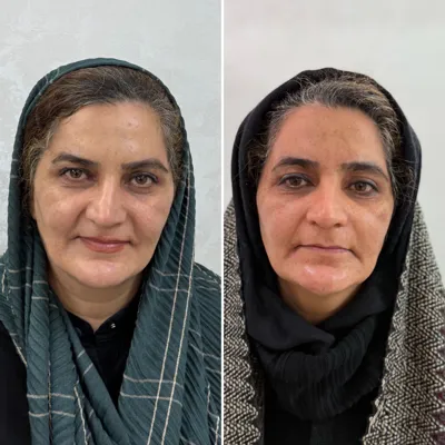 لیزر مو زائد در اصفهان