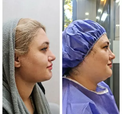 لیزر مو زائد در اصفهان
