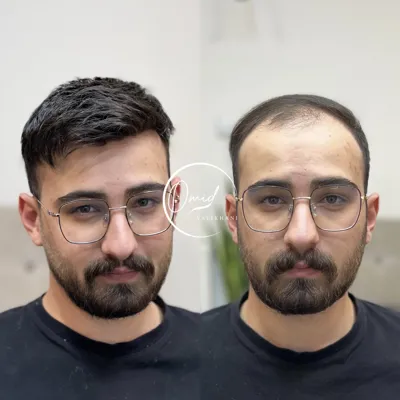 پروتز مو در بهارستان