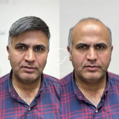 پروتز مو در بهارستان