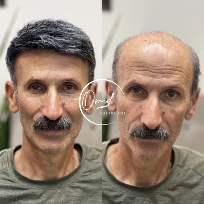 پروتز مو در لردگان