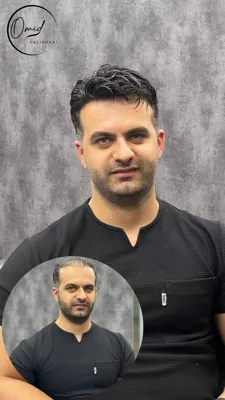 پروتز مو شاهین شهر