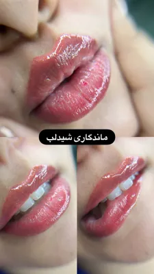 بهترین فیبروزکار کرمان