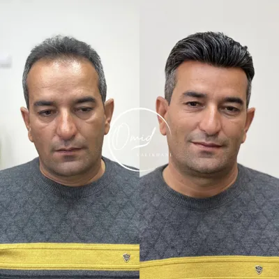 درمان بیماری لیکن پلان