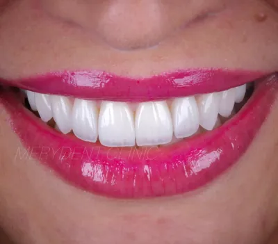 بهترین مرکز کامپوزیت دندان در شیراز