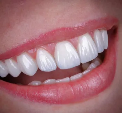 بهترین مرکز کامپوزیت دندان در شیراز