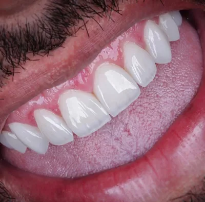 بهترین مرکز کامپوزیت دندان در شیراز