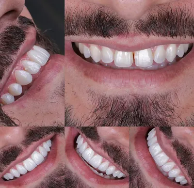 بهترین مرکز کامپوزیت دندان در شیراز