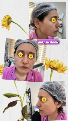 قبل و بعد از هایفوتراپی