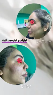 فیلر لب و فیلر سیب گونه